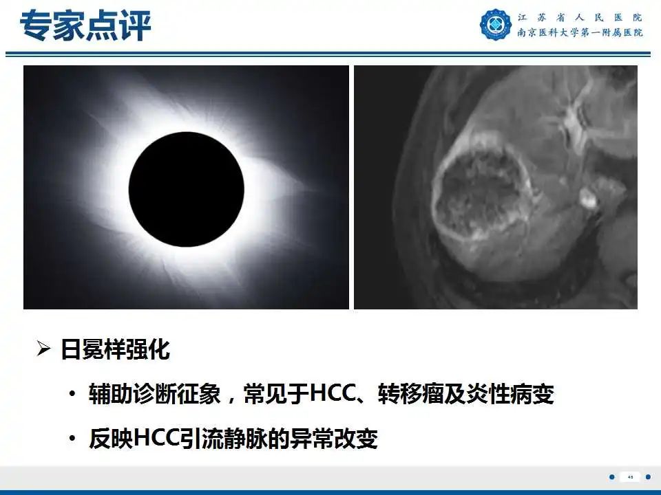 影像PPT - 【PPT】肝细胞癌—肝脏肿瘤术前MR评估-47