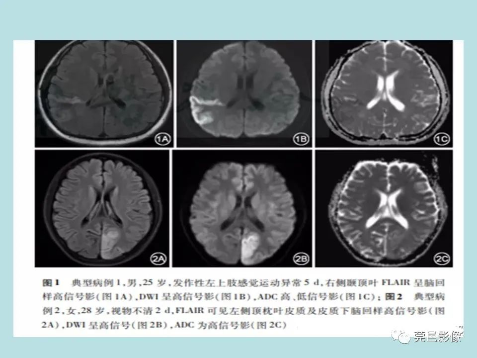影像PPT - 【病例】线粒体脑肌病1例CT及MR-25