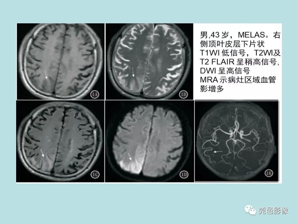 影像PPT - 【病例】线粒体脑肌病1例CT及MR-26