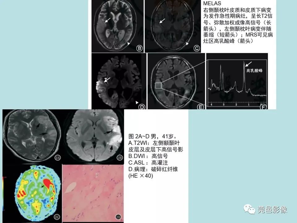影像PPT - 【病例】线粒体脑肌病1例CT及MR-27