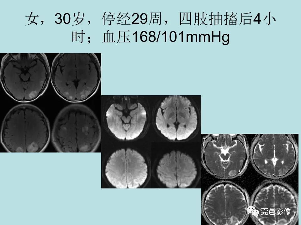 影像PPT - 【病例】线粒体脑肌病1例CT及MR-32