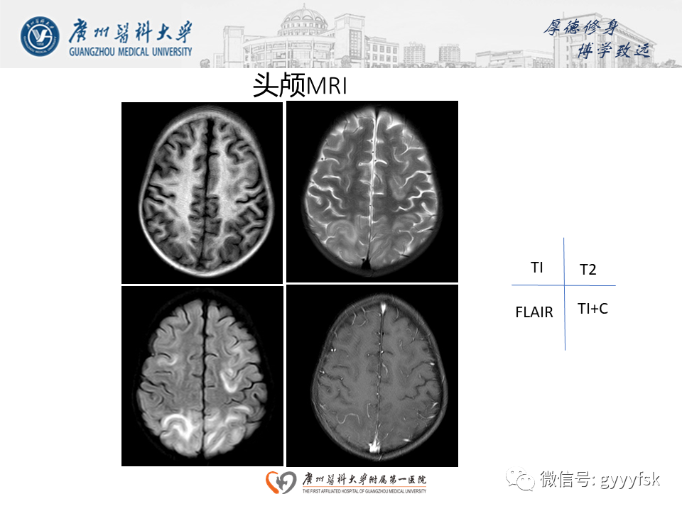 影像PPT - 【病例】可逆性后部脑病综合征（PRES）一例MR-5