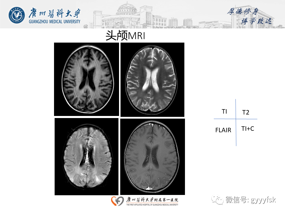 影像PPT - 【病例】可逆性后部脑病综合征（PRES）一例MR-6