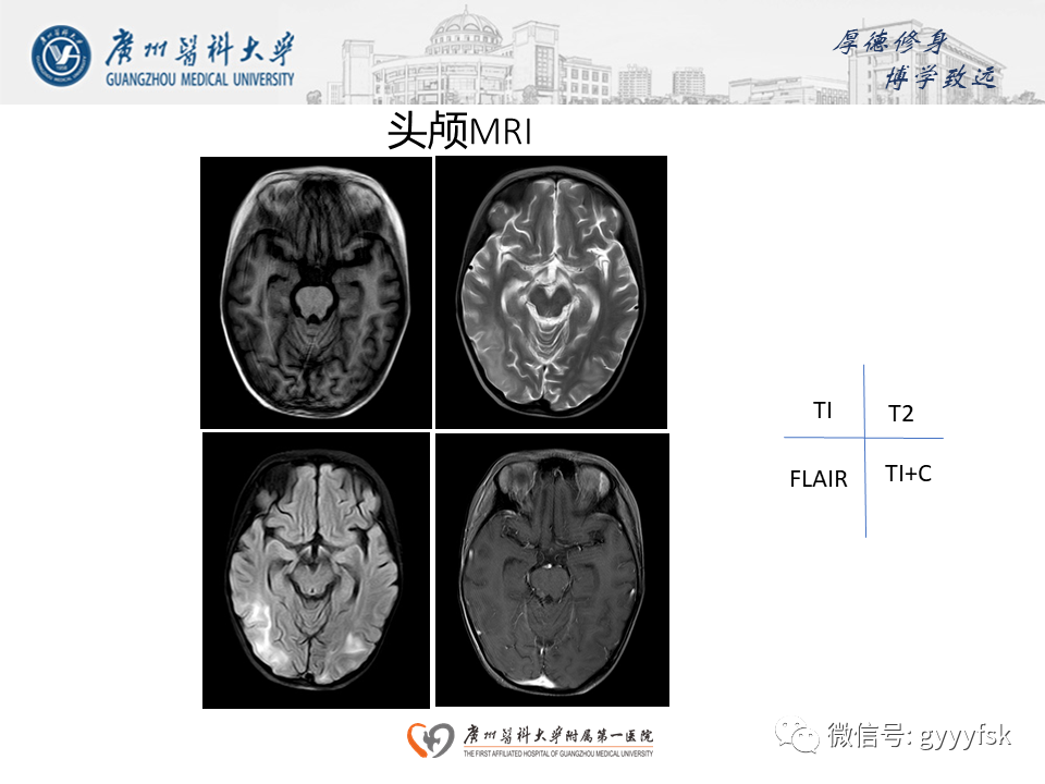 影像PPT - 【病例】可逆性后部脑病综合征（PRES）一例MR-7
