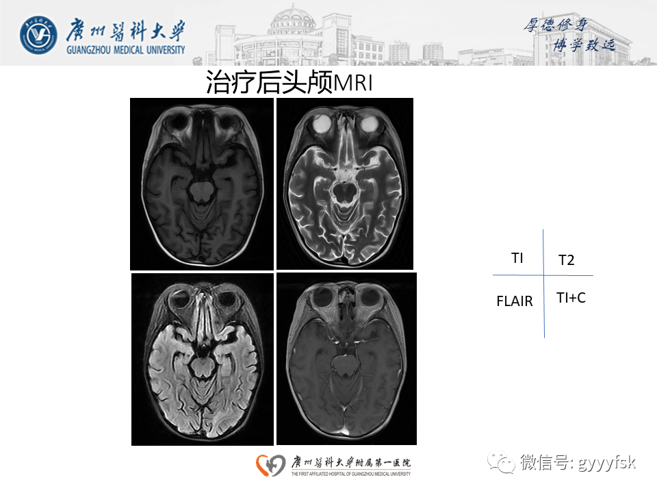 影像PPT - 【病例】可逆性后部脑病综合征（PRES）一例MR-13