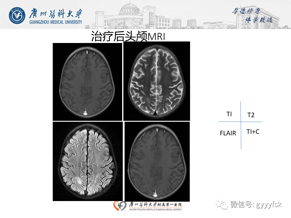 影像PPT - 【病例】可逆性后部脑病综合征（PRES）一例MR-11