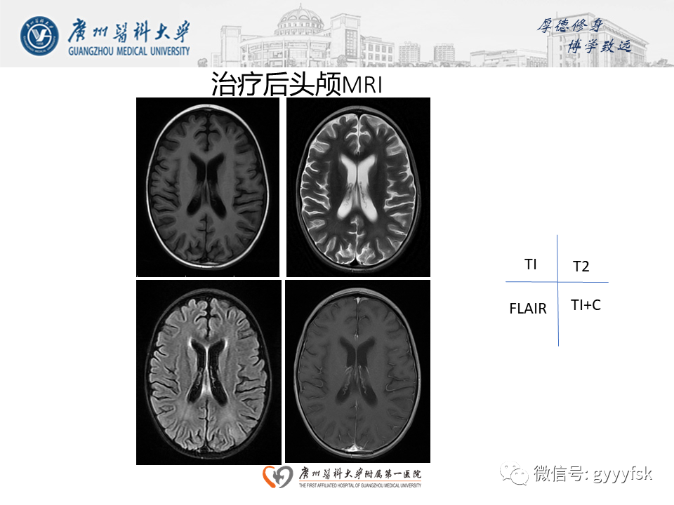影像PPT - 【病例】可逆性后部脑病综合征（PRES）一例MR-12