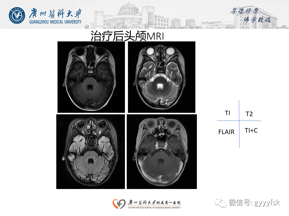 影像PPT - 【病例】可逆性后部脑病综合征（PRES）一例MR-14