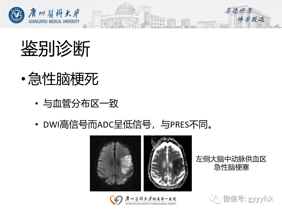 影像PPT - 【病例】可逆性后部脑病综合征（PRES）一例MR-18