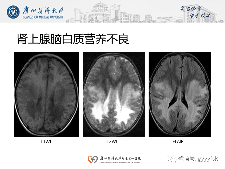 影像PPT - 【病例】可逆性后部脑病综合征（PRES）一例MR-20