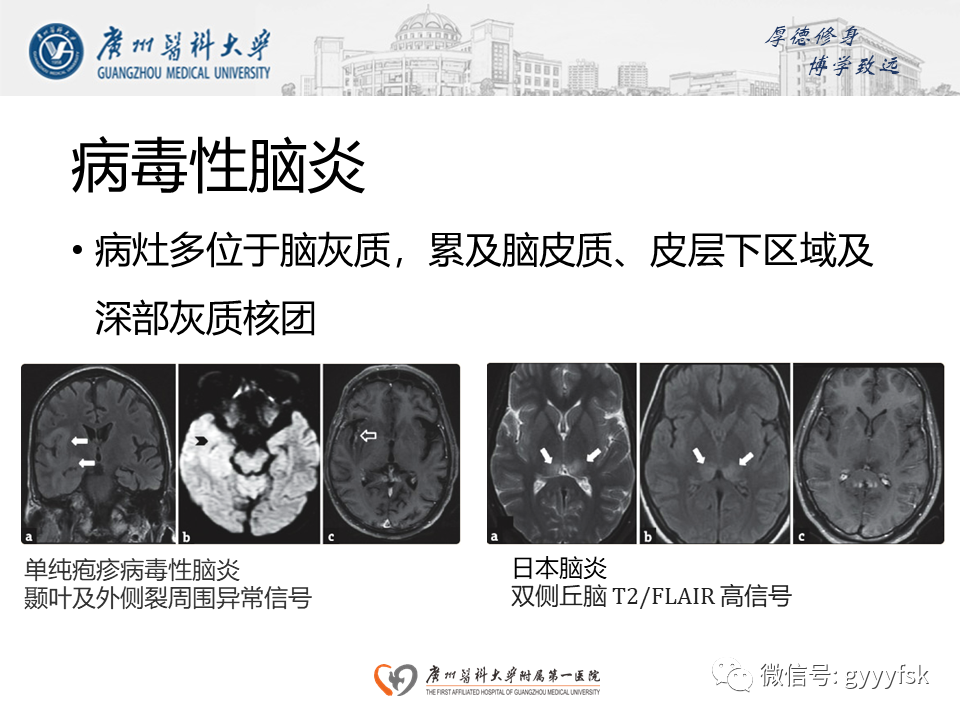 影像PPT - 【病例】可逆性后部脑病综合征（PRES）一例MR-21