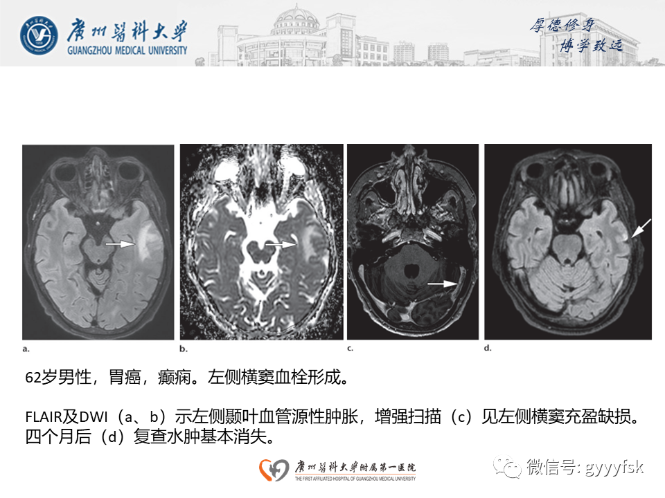 影像PPT - 【病例】可逆性后部脑病综合征（PRES）一例MR-23