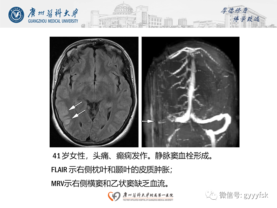 影像PPT - 【病例】可逆性后部脑病综合征（PRES）一例MR-24