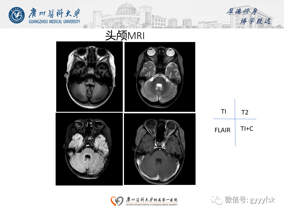 影像PPT - 【病例】可逆性后部脑病综合征（PRES）一例MR-1