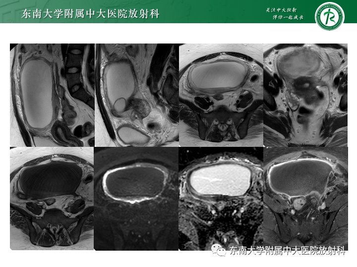 影像PPT - 【病例】附件扭转4例病例随访-2