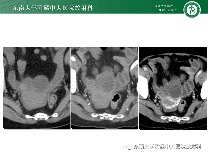 影像PPT - 【病例】附件扭转4例病例随访-5