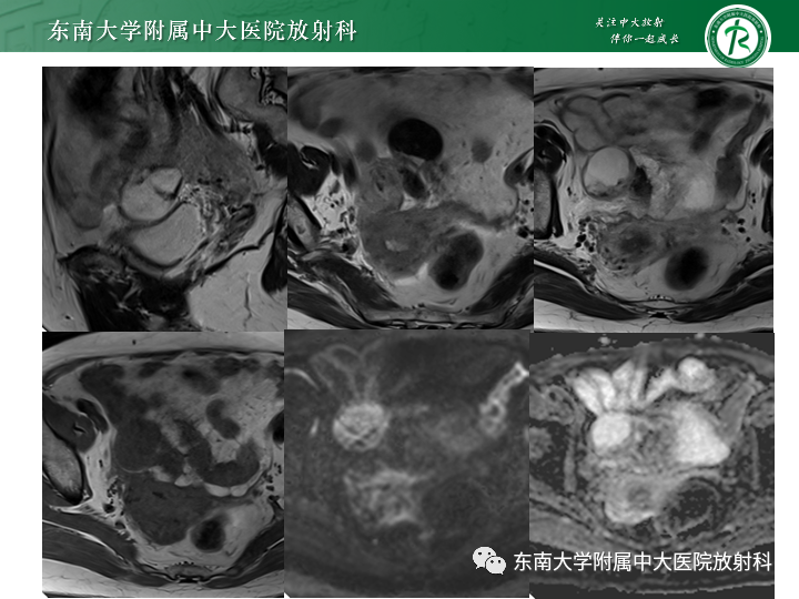 影像PPT - 【病例】附件扭转4例病例随访-6