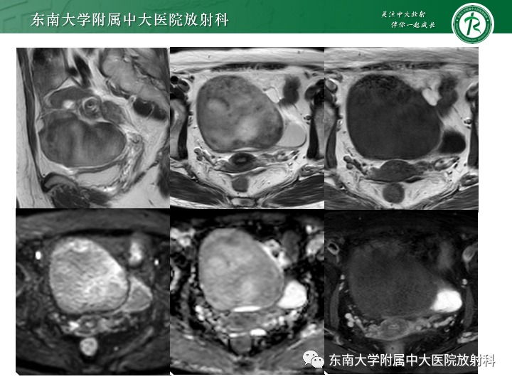 影像PPT - 【病例】附件扭转4例病例随访-9