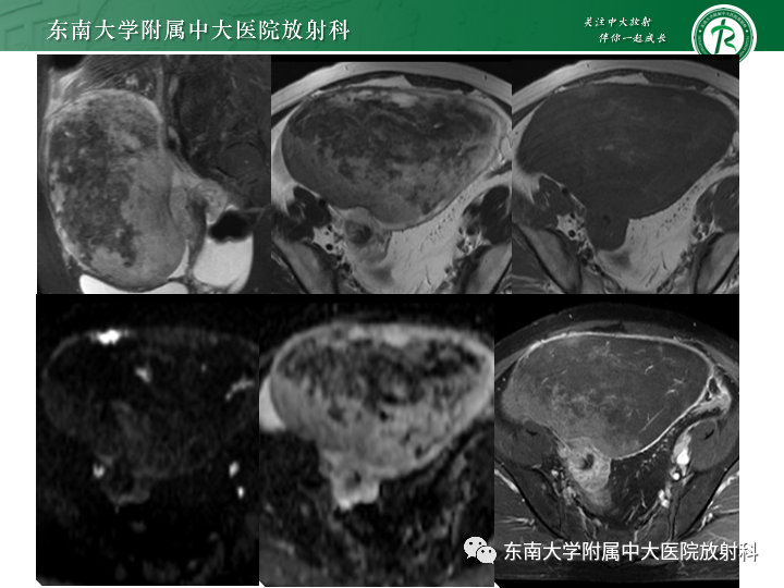 影像PPT - 【病例】附件扭转4例病例随访-12