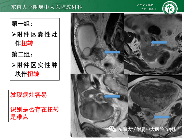 影像PPT - 【病例】附件扭转4例病例随访-17