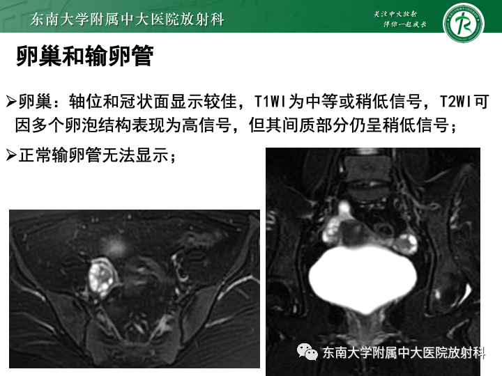 影像PPT - 【病例】附件扭转4例病例随访-19