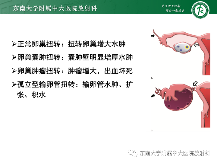 影像PPT - 【病例】附件扭转4例病例随访-26