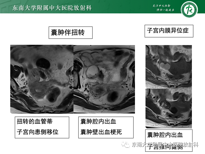 影像PPT - 【病例】附件扭转4例病例随访-29