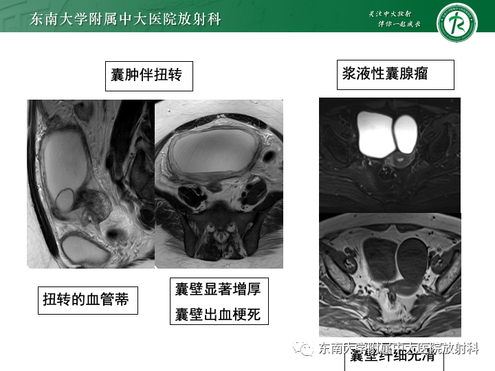 影像PPT - 【病例】附件扭转4例病例随访-30