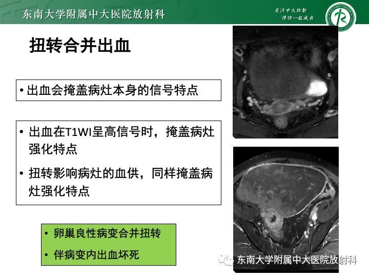 影像PPT - 【病例】附件扭转4例病例随访-31