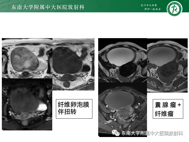 影像PPT - 【病例】附件扭转4例病例随访-32