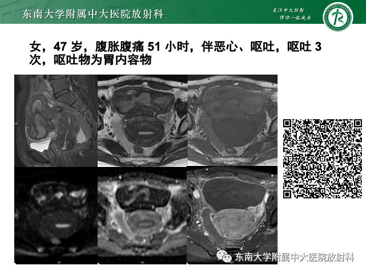 影像PPT - 【病例】附件扭转4例病例随访-34