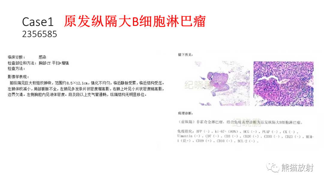 影像PPT - 【PPT】儿童及青少年前纵隔肿瘤-12