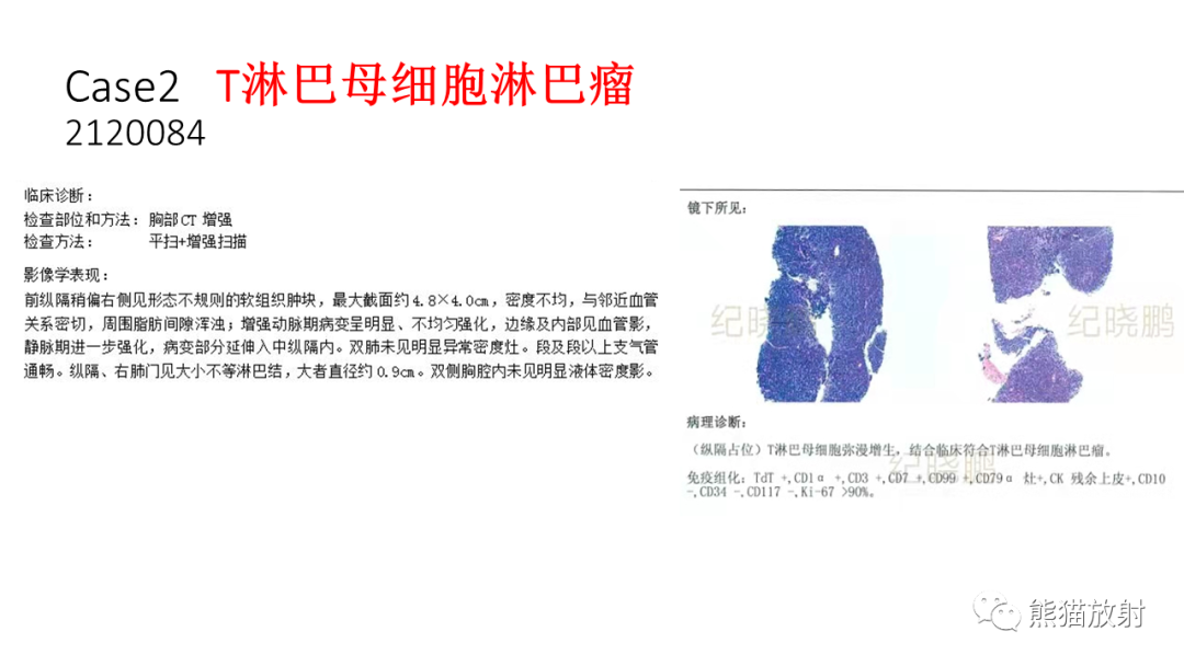 影像PPT - 【PPT】儿童及青少年前纵隔肿瘤-13