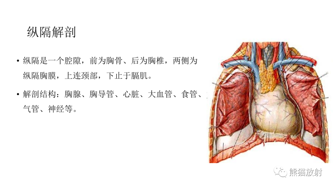 影像PPT - 【PPT】儿童及青少年前纵隔肿瘤-15