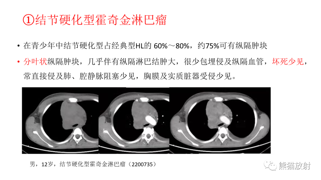 影像PPT - 【PPT】儿童及青少年前纵隔肿瘤-21