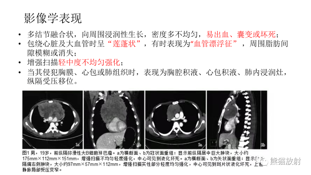 影像PPT - 【PPT】儿童及青少年前纵隔肿瘤-23