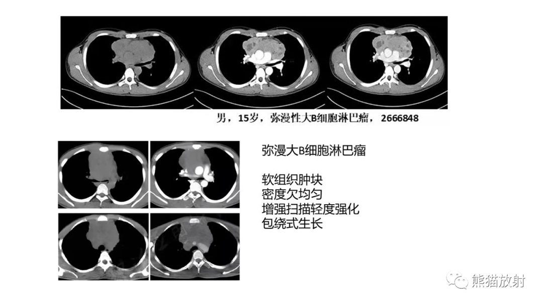 影像PPT - 【PPT】儿童及青少年前纵隔肿瘤-24