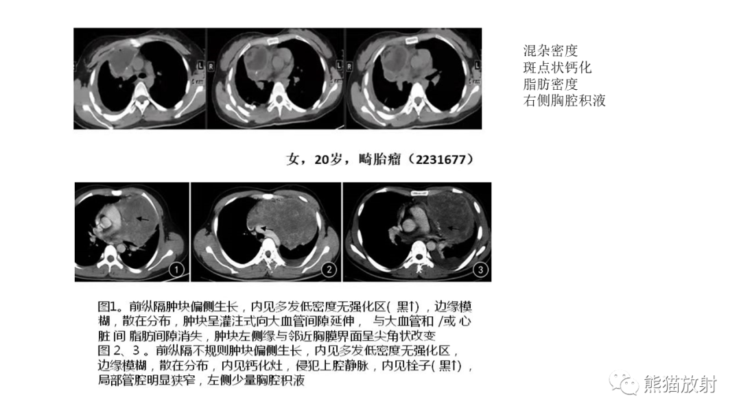影像PPT - 【PPT】儿童及青少年前纵隔肿瘤-30