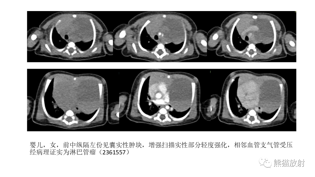 影像PPT - 【PPT】儿童及青少年前纵隔肿瘤-39