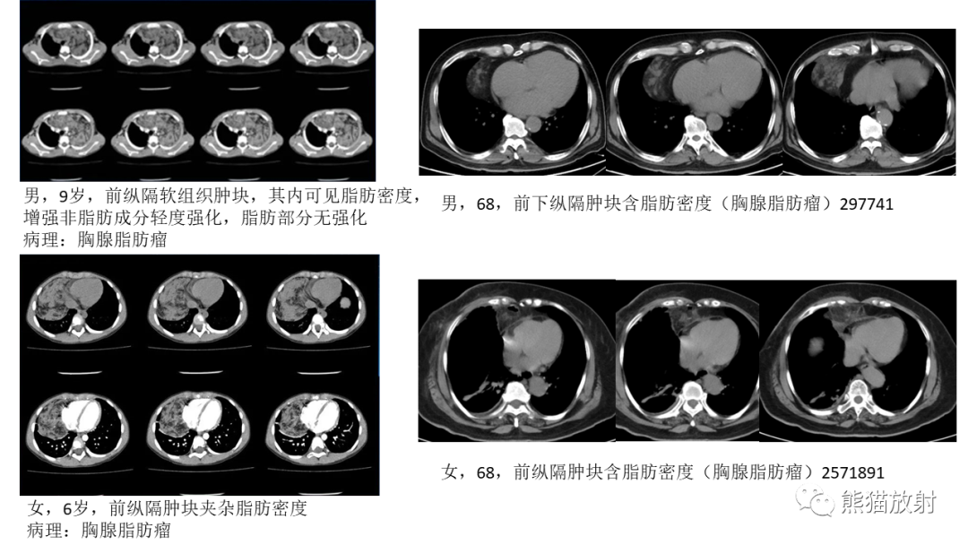 影像PPT - 【PPT】儿童及青少年前纵隔肿瘤-41