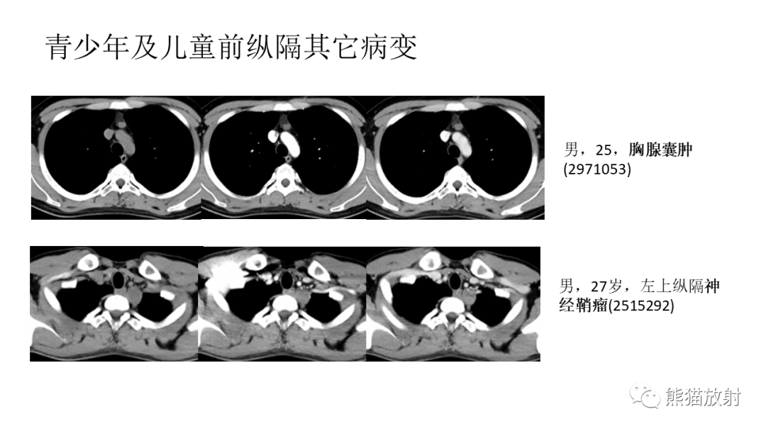 影像PPT - 【PPT】儿童及青少年前纵隔肿瘤-42