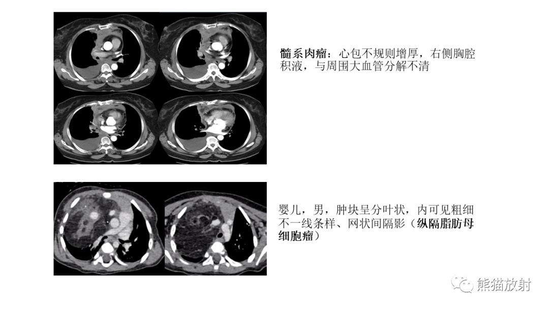 影像PPT - 【PPT】儿童及青少年前纵隔肿瘤-43