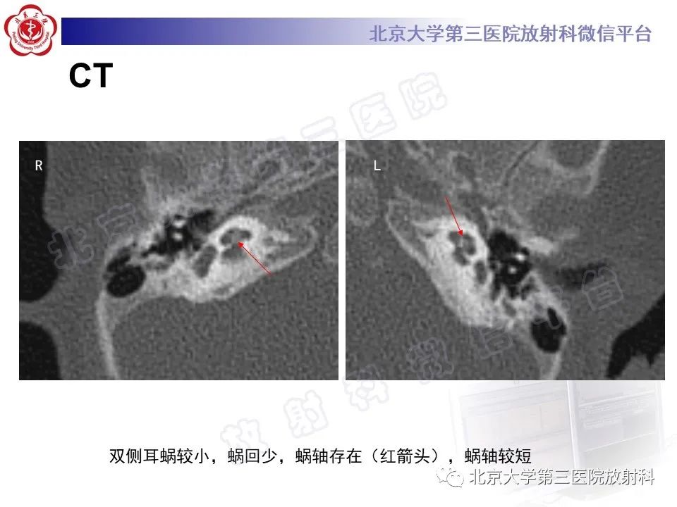 影像PPT - 【PPT】内耳发育畸形-3