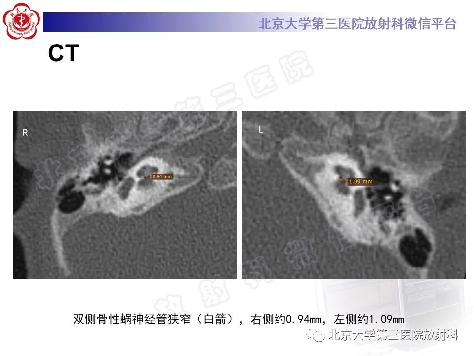影像PPT - 【PPT】内耳发育畸形-5