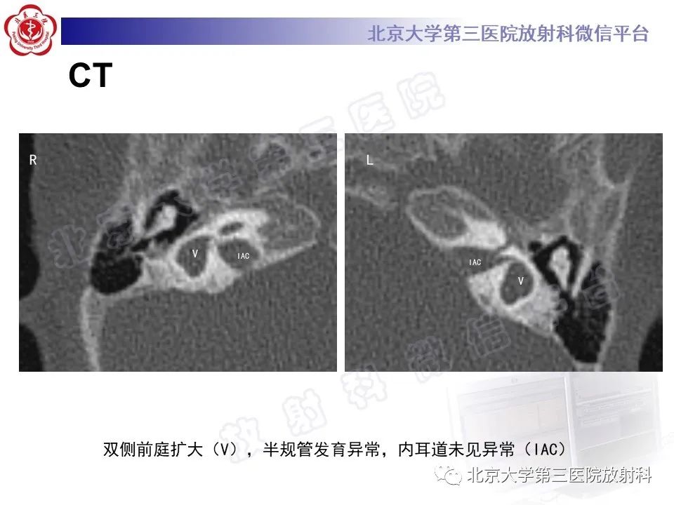 影像PPT - 【PPT】内耳发育畸形-4
