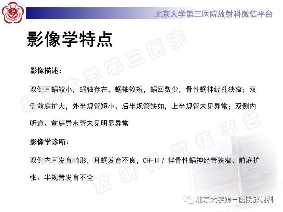 影像PPT - 【PPT】内耳发育畸形-6