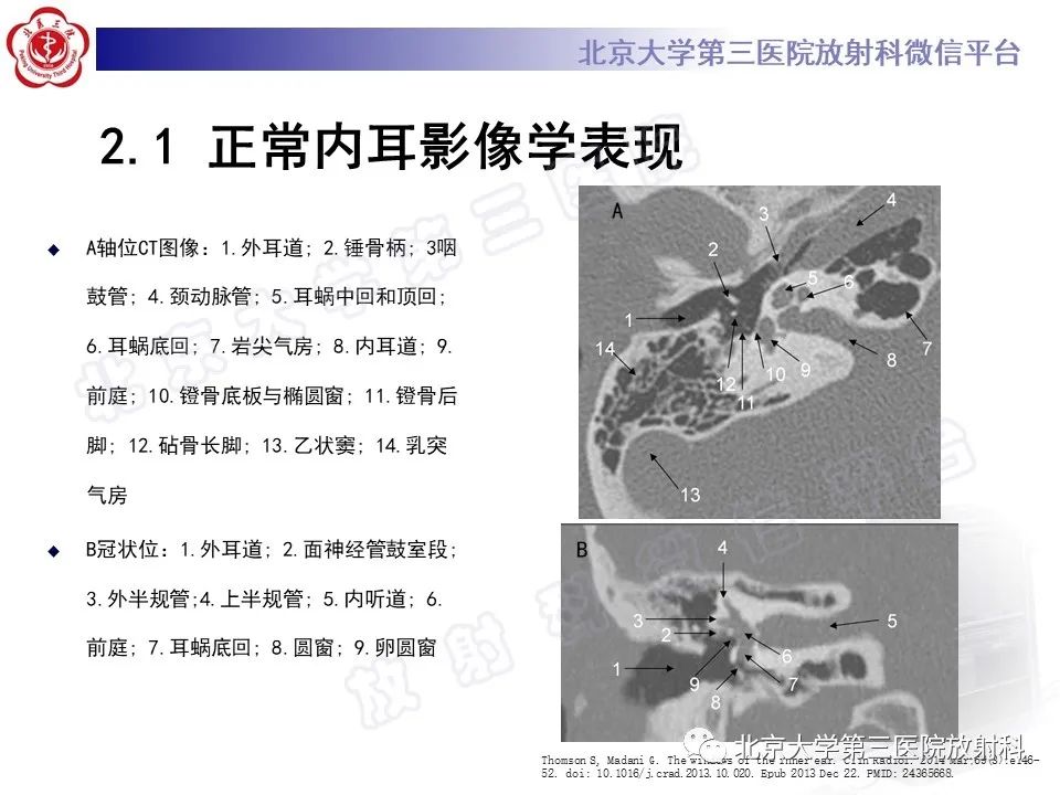 影像PPT - 【PPT】内耳发育畸形-16
