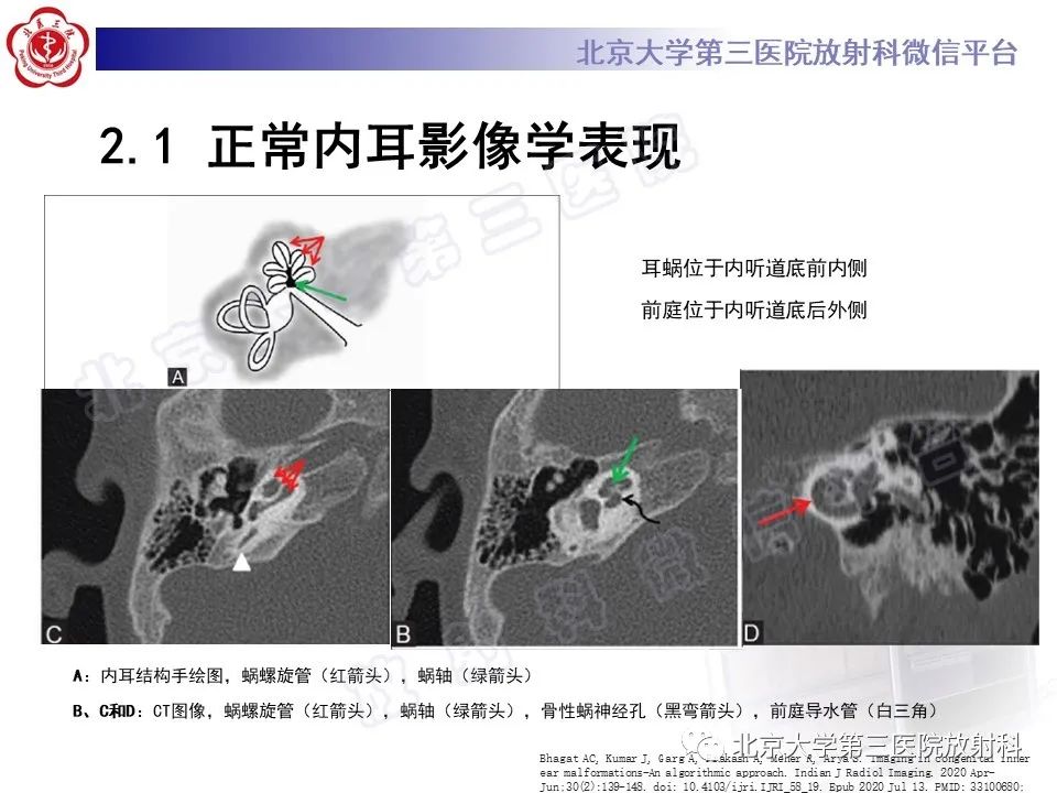 影像PPT - 【PPT】内耳发育畸形-17