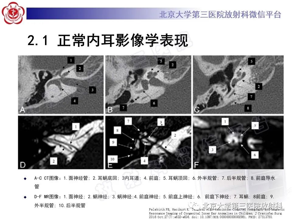 影像PPT - 【PPT】内耳发育畸形-18