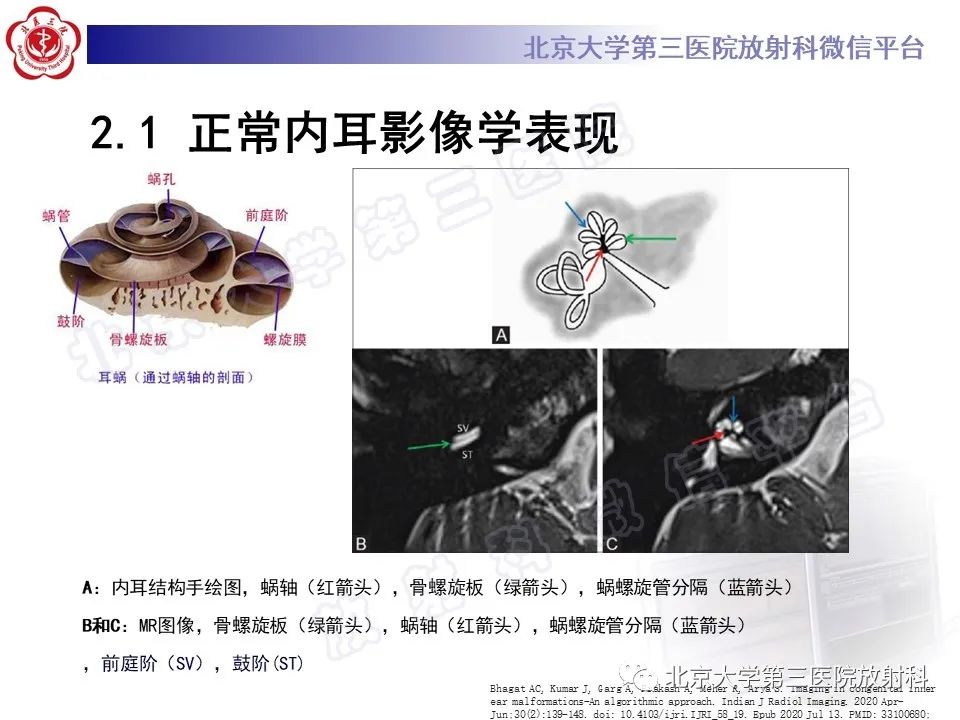 影像PPT - 【PPT】内耳发育畸形-19